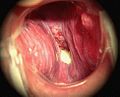 Causes, symptoms and treatment of Laryngitis