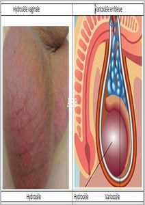 Hydrocele Defintion Causes How to Shrink Hydrocele Naturally