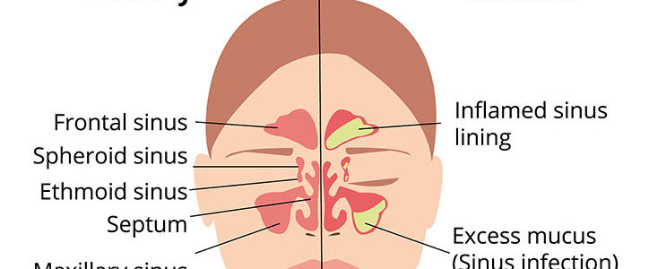 Sinusitis Natural Definitive Remedy
