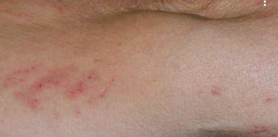10 Best Home Remedies For Lupus
