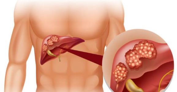 Hepatitis B