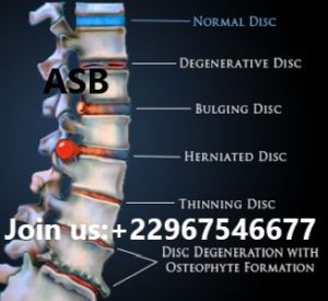 degenerative disc disease natural supplements