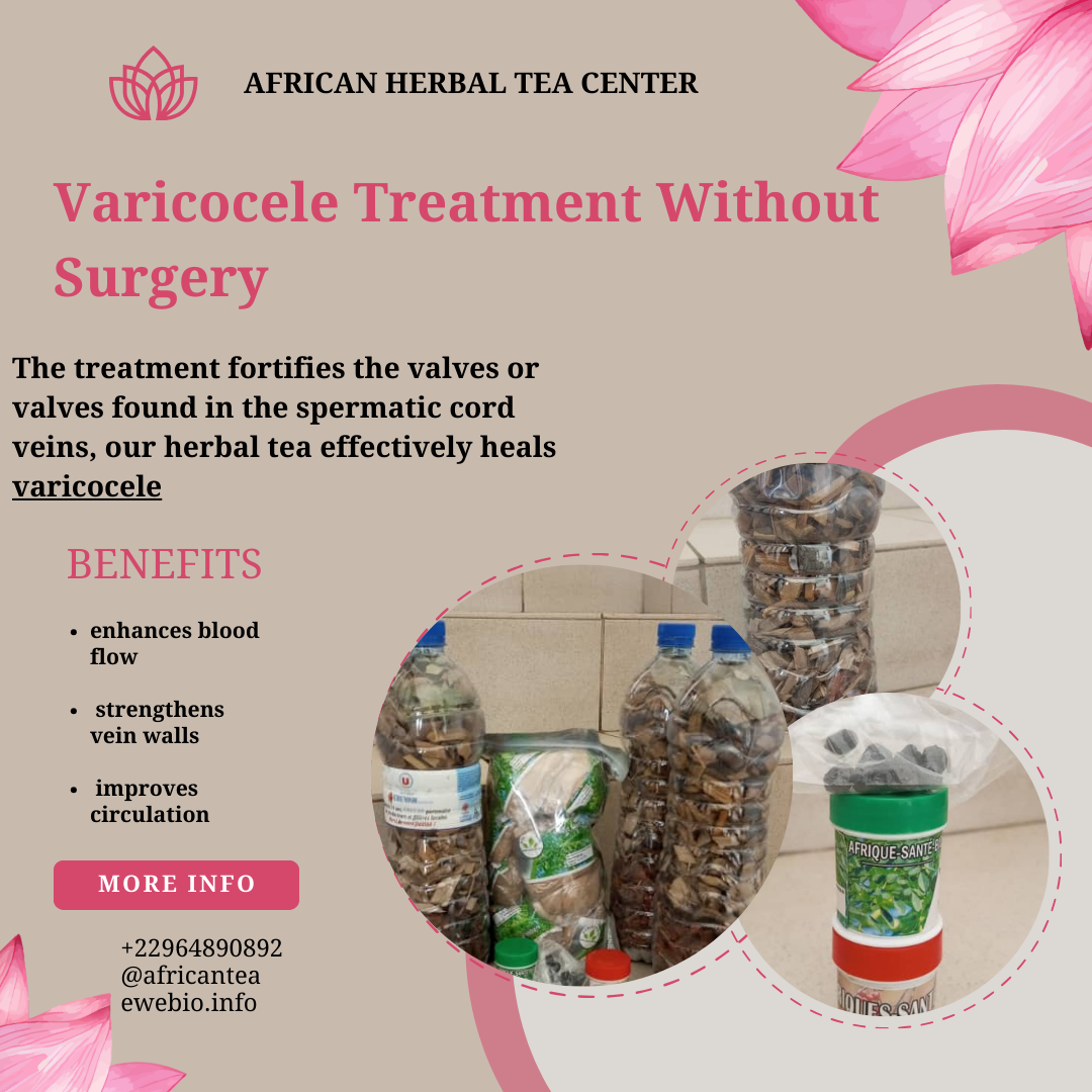Varicocele Treatment Without Surgery