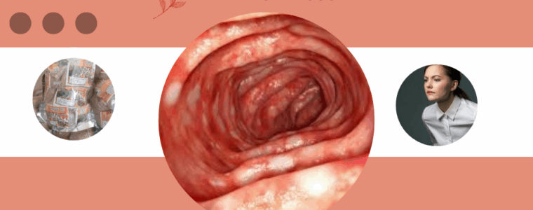 Ulcerative Proctitis Natural Treatment